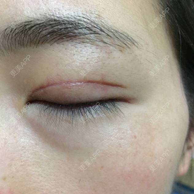 小花的全切双眼皮日记