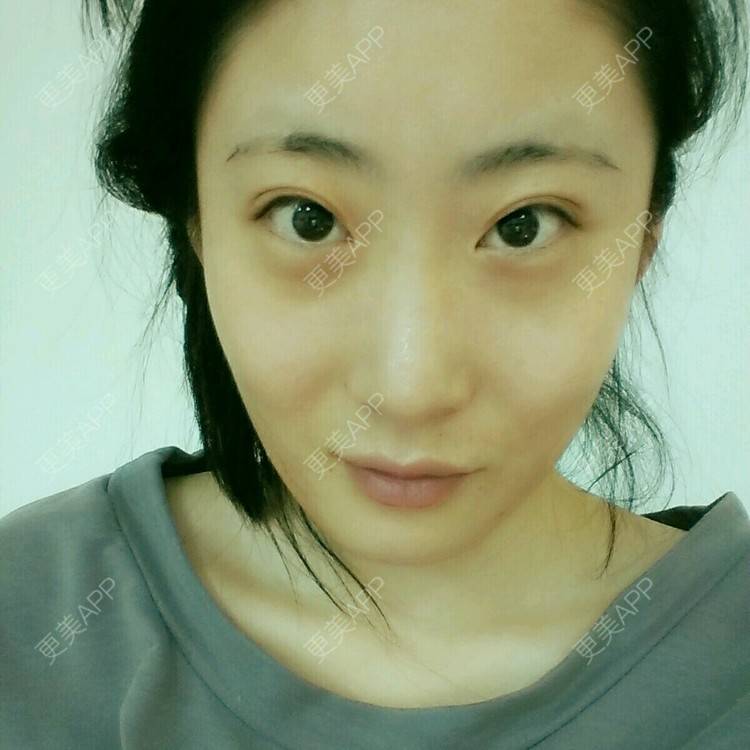 更美 - 壮壮的经验 | 鼻部多项