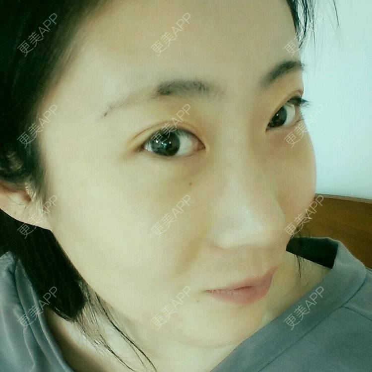 更美 - 壮壮的经验 | 鼻部多项