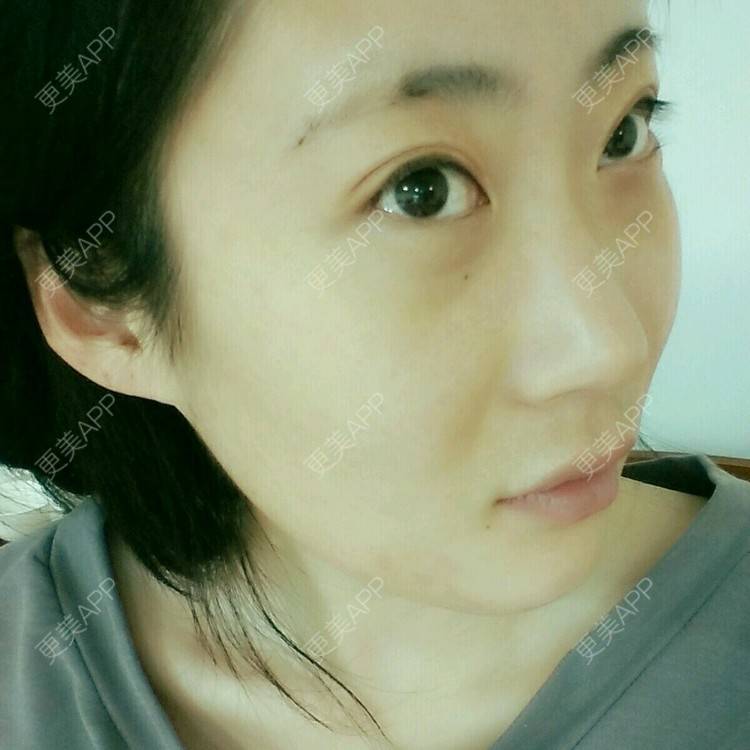 更美 - 壮壮的经验 | 鼻部多项