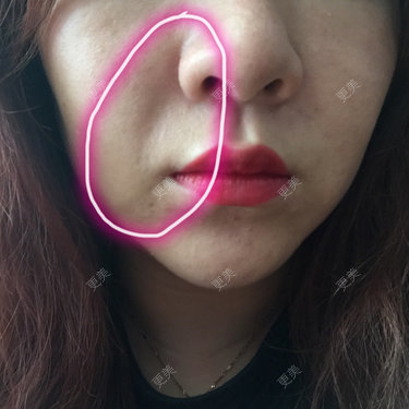 玻尿酸填鼻唇沟失败图图片