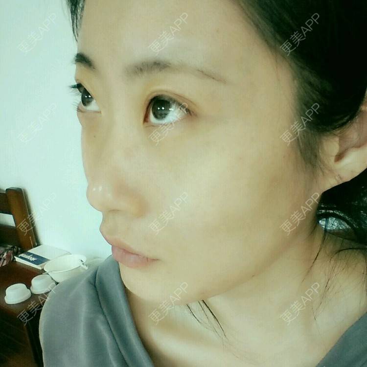 更美 - 壮壮的经验 | 鼻部多项