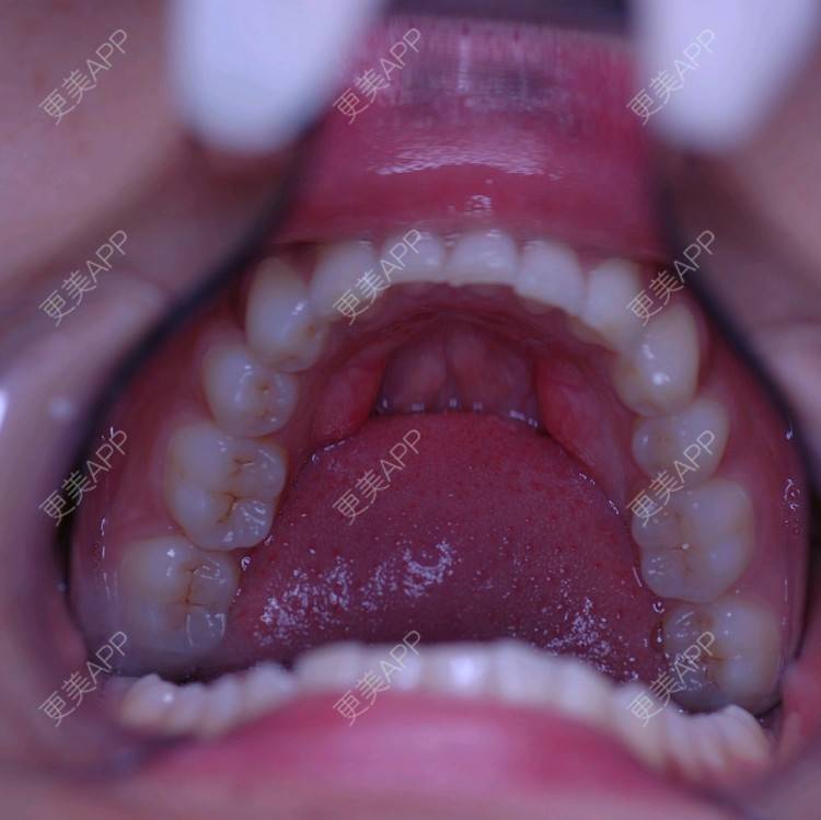 更美 - 更美用户u7WUUmjllY的牙齿矫正经验 | 注射美容 | 面部轮廓 | 牙列拥挤 | 口腔齿科 | 龅牙 | 虎牙 | 牙齿稀疏 | 错颌锁颌 | 胶原蛋白填充苹果肌 | 下颌角 | 牙齿矫正 | 洗牙 | 北京