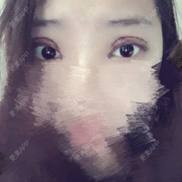 更美 - 更美用户Vn5IjUrHUh的经验 | 全切开双眼皮 | 切开内眼角