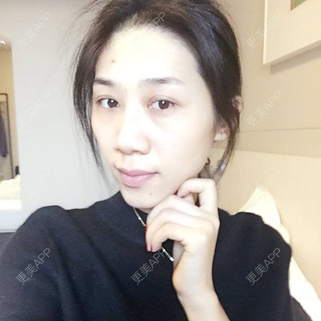 更美 - 小林最近的经验 | 硅胶丰太阳穴 | 自体脂肪填充额头 | 长春