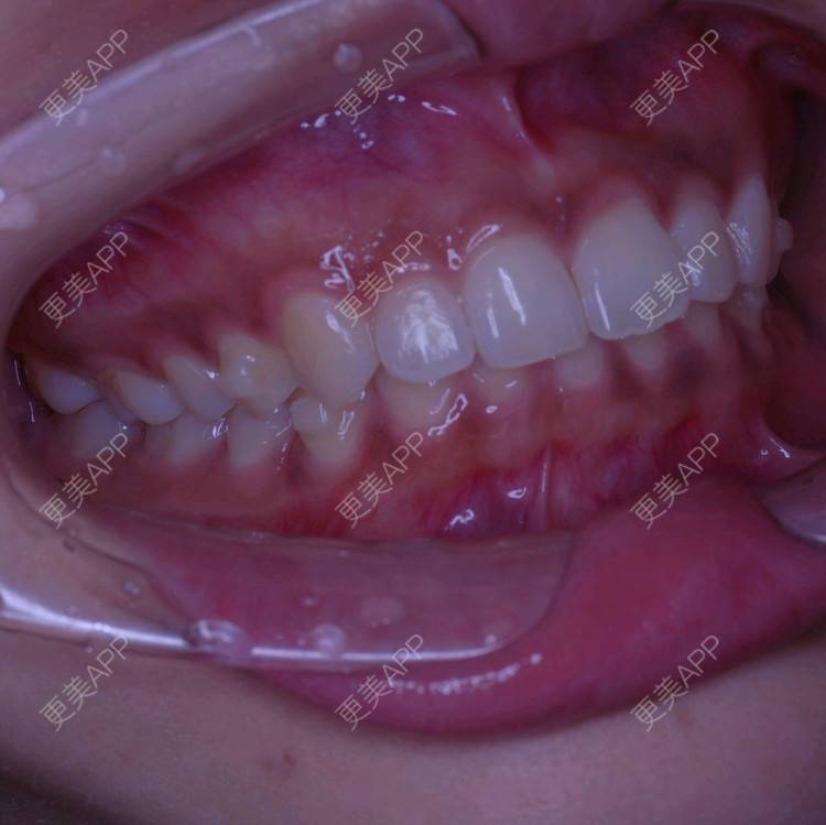 更美 - 更美用户u7WUUmjllY的牙齿矫正经验 | 注射美容 | 面部轮廓 | 牙列拥挤 | 口腔齿科 | 龅牙 | 虎牙 | 牙齿稀疏 | 错颌锁颌 | 胶原蛋白填充苹果肌 | 下颌角 | 牙齿矫正 | 洗牙 | 北京