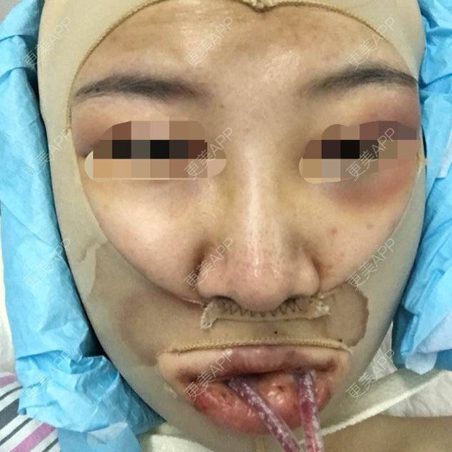 假体垫下巴 | 深圳