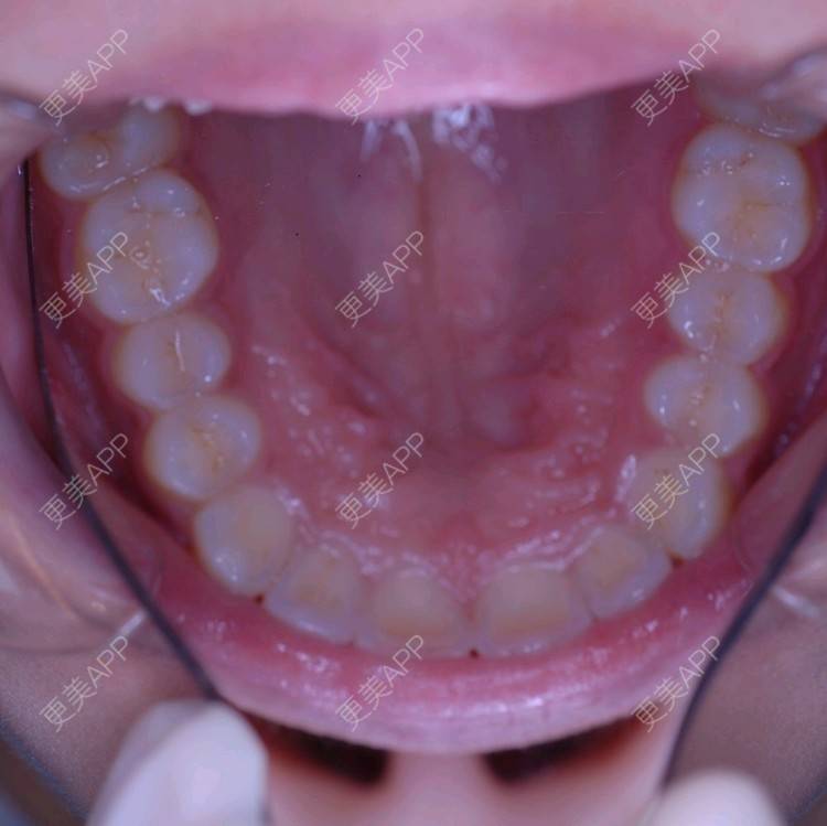 更美 - 更美用户u7WUUmjllY的牙齿矫正经验 | 注射美容 | 面部轮廓 | 牙列拥挤 | 口腔齿科 | 龅牙 | 虎牙 | 牙齿稀疏 | 错颌锁颌 | 胶原蛋白填充苹果肌 | 下颌角 | 牙齿矫正 | 洗牙 | 北京