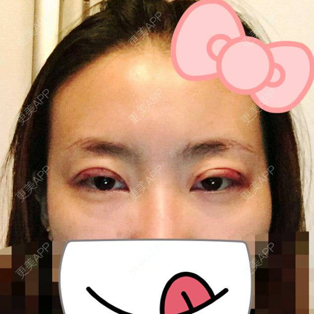 更美 - 清泉石上游的外切去眼袋经验 | 美购日记 | 术后求抱抱 | 你看我整哪 | 外切去眼袋 | 双眼皮微创 | 北京