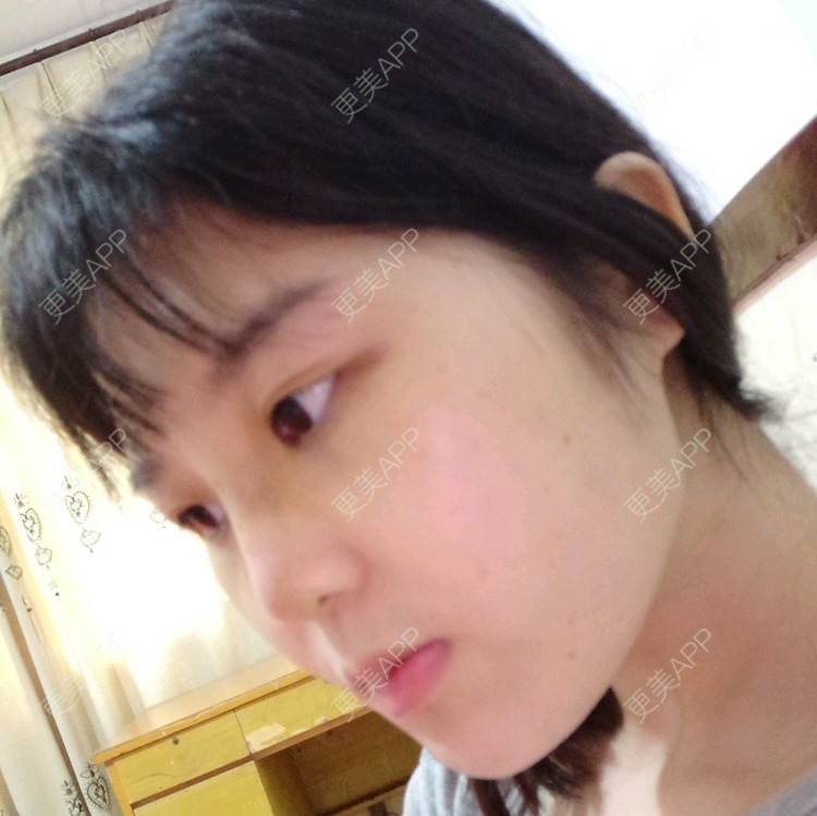 更美 - 洋洋啊的经验 | 隆鼻 | 硅胶隆鼻 | 武汉