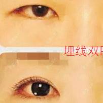 更美 - 崔剑 医生的经验 | 双眼皮手术 | 双眼皮切开 | 埋线双眼皮 | 上海