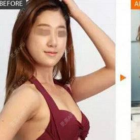 更美 - 崔剑 医生的经验 | 隆胸 | 假体丰胸 | 自体脂肪隆胸 | 上海