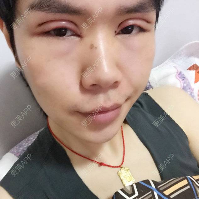 更美 - 陈熙芷的定点双眼皮经验 | 厦门 | 定点双眼皮