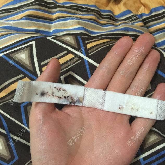 更美 - 陈熙芷的定点双眼皮经验 | 厦门 | 定点双眼皮