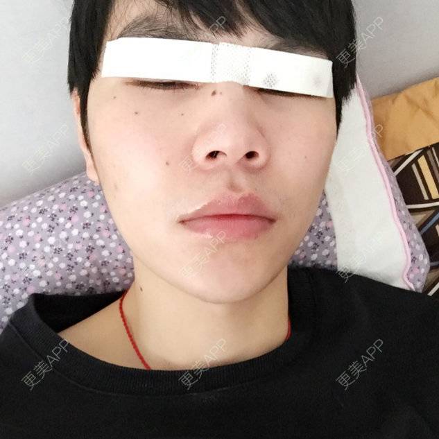 更美 - 陈熙芷的定点双眼皮经验 | 开内眼角 | 眼部整形 | 厦门 | 定点双眼皮 | 双眼皮