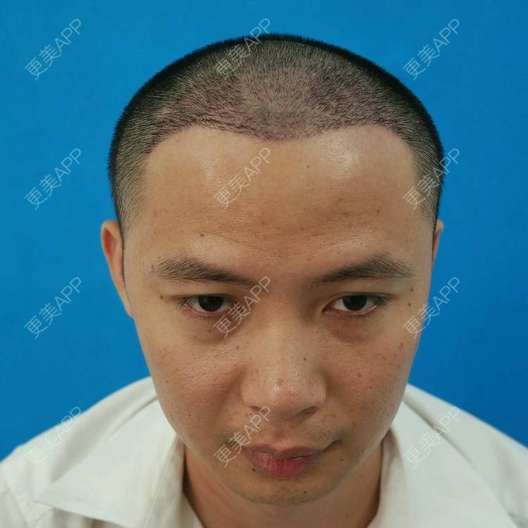 更美 - 曾浩 医生的经验 | 植发其他项目 | 广州 | 面部轮廓 | 永久植发 | 毛发种植