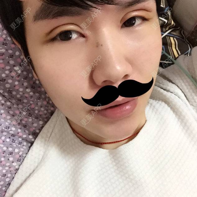 更美 - 陈熙芷的定点双眼皮经验 | 厦门 | 定点双眼皮