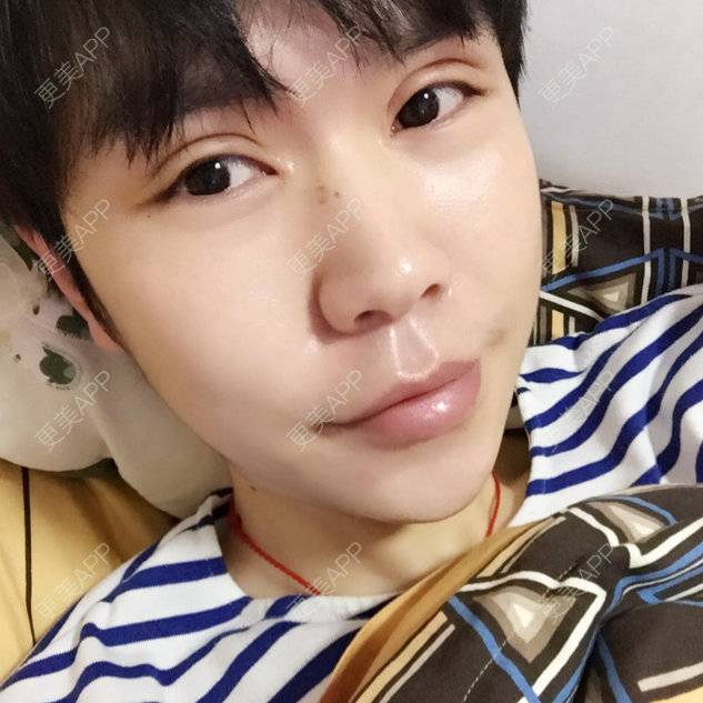 更美 - 陈熙芷的定点双眼皮经验 | 厦门 | 定点双眼皮