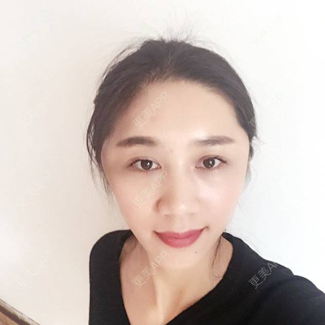 更美 - 小林最近的经验 | 硅胶丰太阳穴 | 自体脂肪填充额头 | 长春