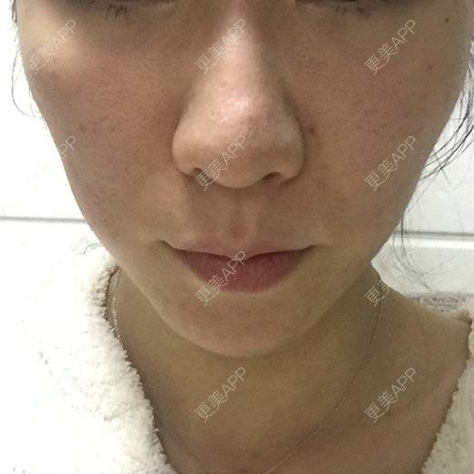 更美 - Bunny小姐的玻尿酸太阳穴经验 | 美购日记 | 玻尿酸太阳穴 | 上海
