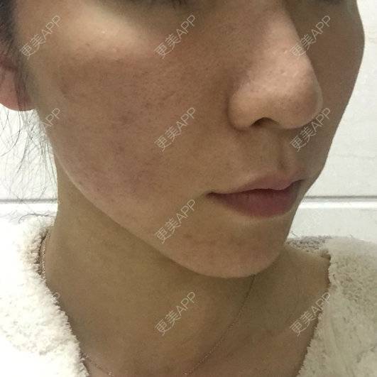 更美 - Bunny小姐的玻尿酸太阳穴经验 | 美购日记 | 玻尿酸太阳穴 | 上海