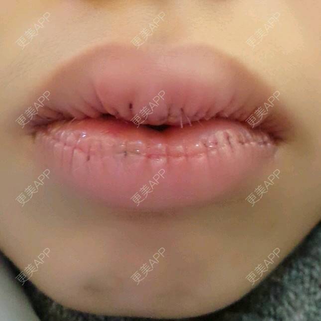 更美 - Grace潼的厚唇改薄经验 | M唇成形 | 武汉 | 厚唇改薄