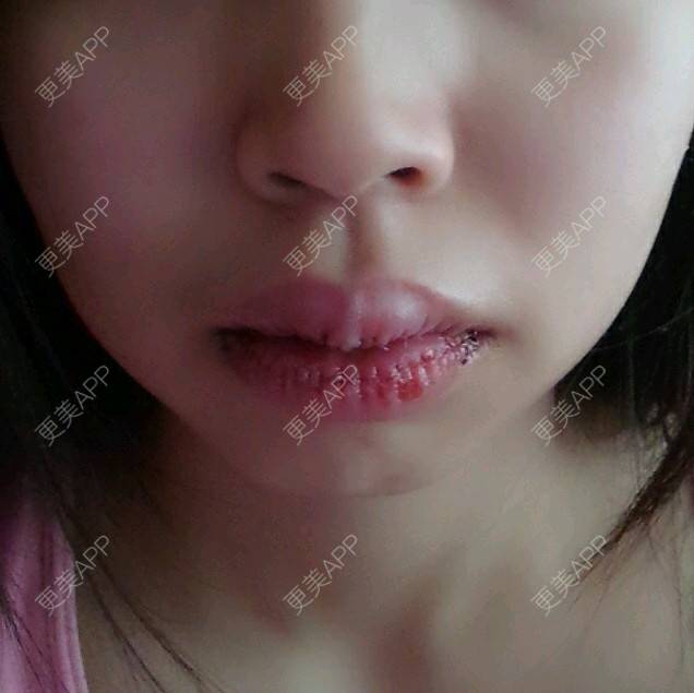 更美 - Grace潼的厚唇改薄经验 | M唇成形 | 武汉 | 厚唇改薄