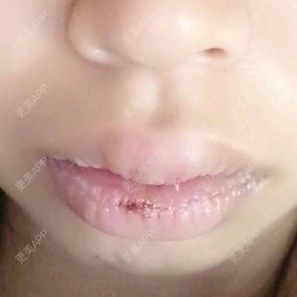 更美 - Grace潼的厚唇改薄经验 | M唇成形 | 武汉 | 厚唇改薄