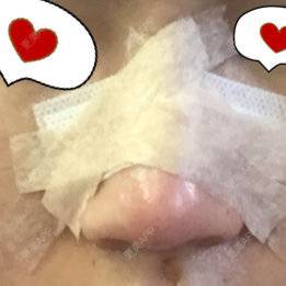 更美 - 心心念念心的经验 | 鼻翼软骨缩合 | 鼻小柱延长 | 美购日记 | 鼻部多项 | 广州