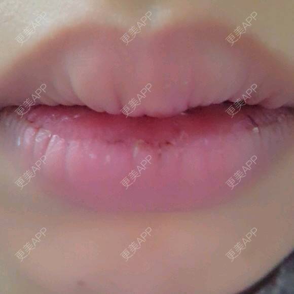 更美 - Grace潼的厚唇改薄经验 | M唇成形 | 武汉 | 厚唇改薄