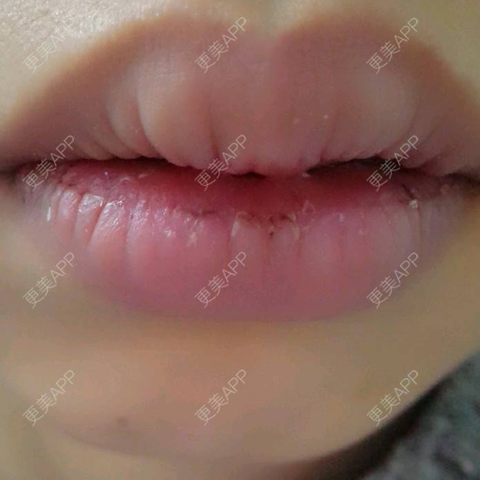 更美 - Grace潼的厚唇改薄经验 | M唇成形 | 武汉 | 厚唇改薄