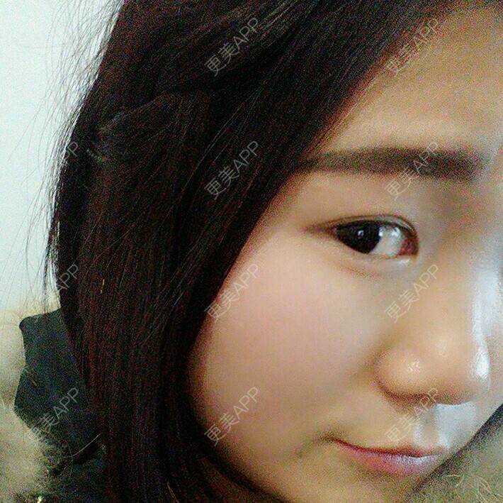 更美 - Guoin💦的玻尿酸经验 | 美购日记 | 术后求抱抱 | 注射玻尿酸 | 玻尿酸 | 郑州