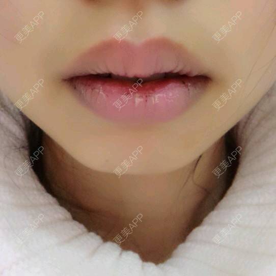 更美 - Grace潼的厚唇改薄经验 | M唇成形 | 武汉 | 厚唇改薄