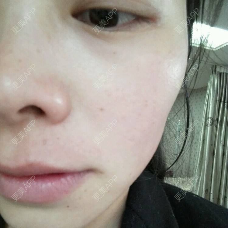 更美 - 哈哈豆豆龙的经验 | 皮肤美容 | 光子嫩肤 | 激光永久脱毛 | 昆明