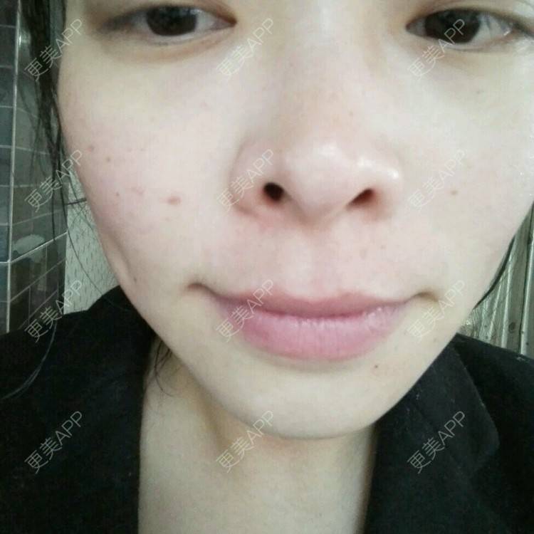 更美 - 哈哈豆豆龙的经验 | 皮肤美容 | 光子嫩肤 | 激光永久脱毛 | 昆明