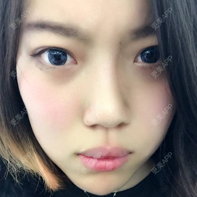 更美 - 更美用户qSB0r1Jjtp的玻尿酸唇部经验 | 注射美容 | 玻尿酸唇部 | 丰唇珠