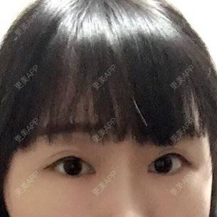 更美 - 呵呵喵的经验 | 瞿敏 | 韩式三点双眼皮 | 武汉
