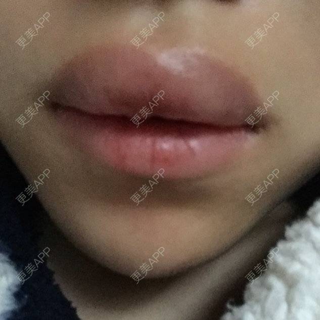 更美 - 更美用户qSB0r1Jjtp的玻尿酸唇部经验 | 注射美容 | 玻尿酸唇部 | 丰唇珠