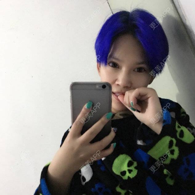 更美 - PERSONALITY-397的经验 | 鼻部整形 | 自体软骨垫鼻尖 | 缩鼻翼 | 无锡