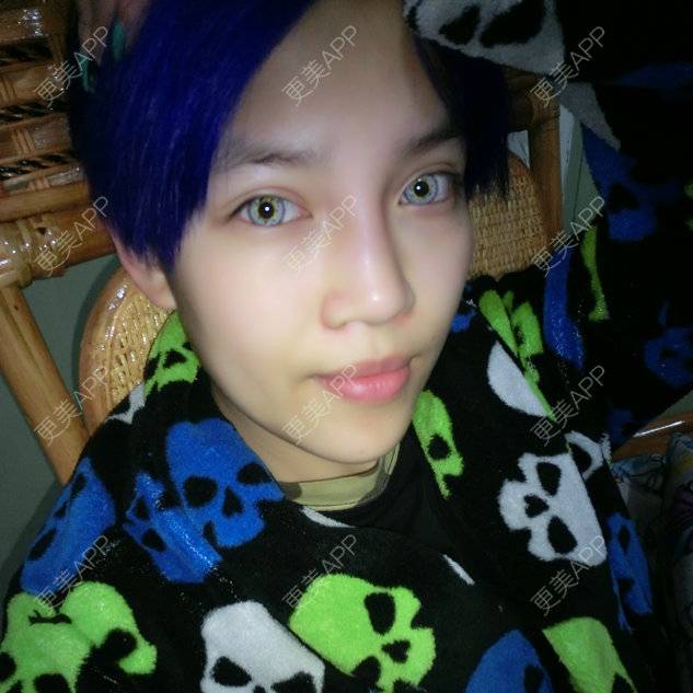 更美 - PERSONALITY-397的经验 | 鼻部整形 | 自体软骨垫鼻尖 | 缩鼻翼 | 无锡