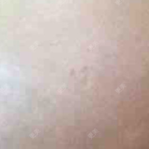微整修复
