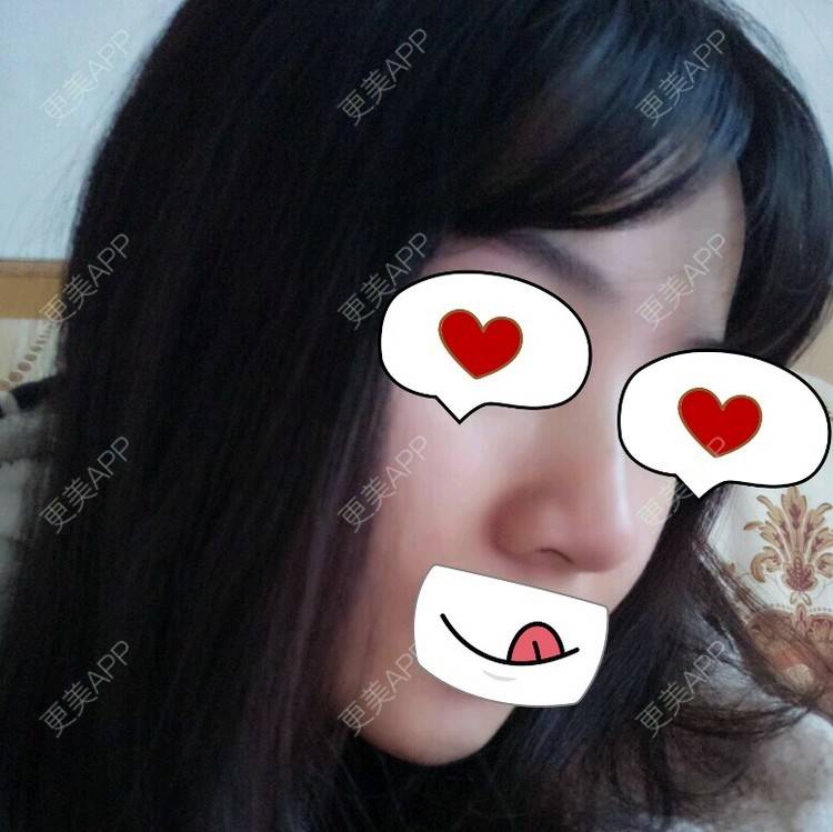 更美 - Rubby的玻尿酸鼻部经验 | 玻尿酸鼻部 | 脱发际线 | 长沙