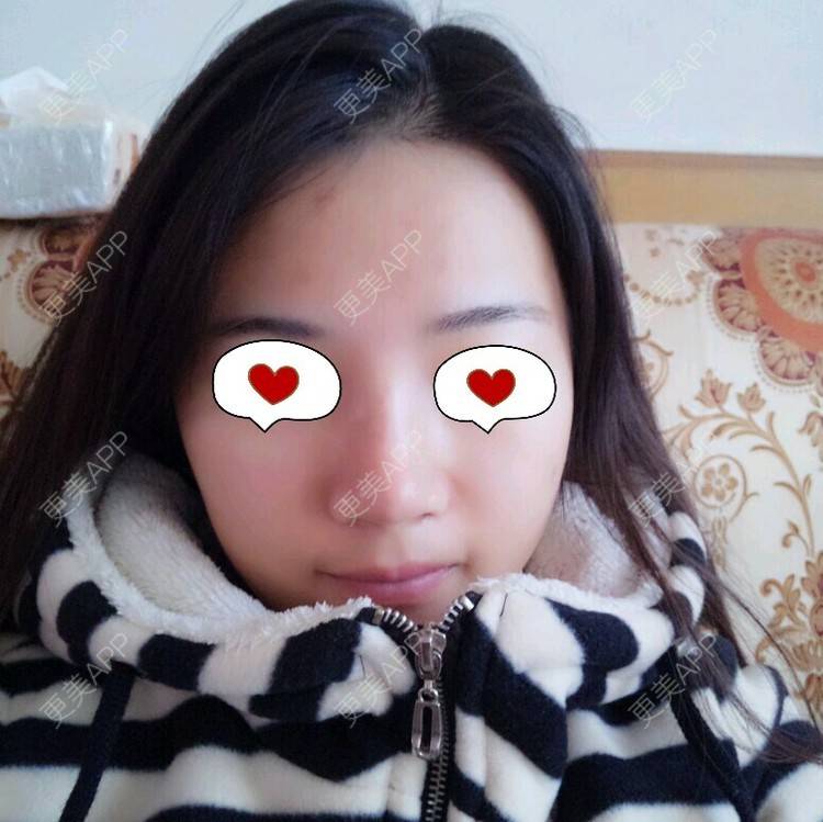更美 - Rubby的激光脱发际线经验 | 激光脱发际线 | 长沙