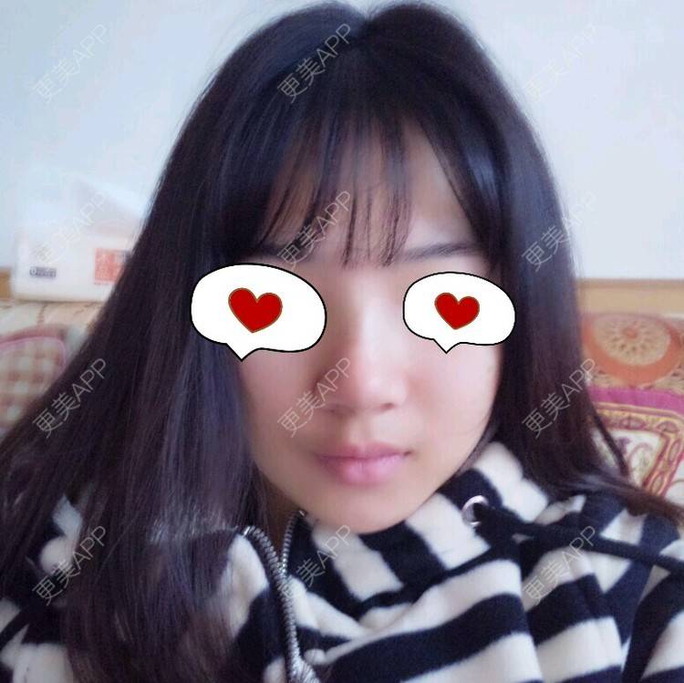 更美 - Rubby的激光脱发际线经验 | 激光脱发际线 | 长沙
