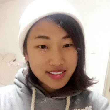 双眼皮