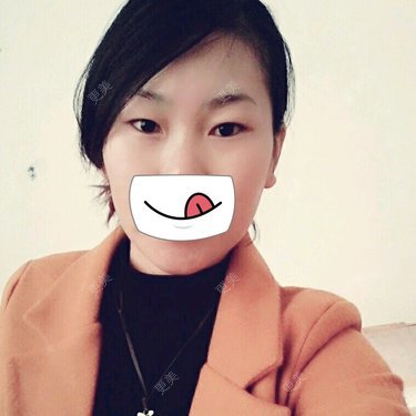 双眼皮