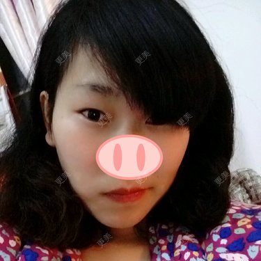 双眼皮