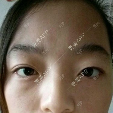 双眼皮