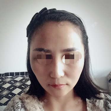 隆鼻