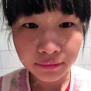 双眼皮